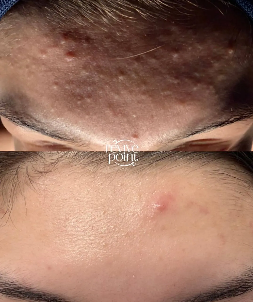 Before and after the Revive Point acne program: forehead with active breakouts before, visibly clearer and calmer skin after