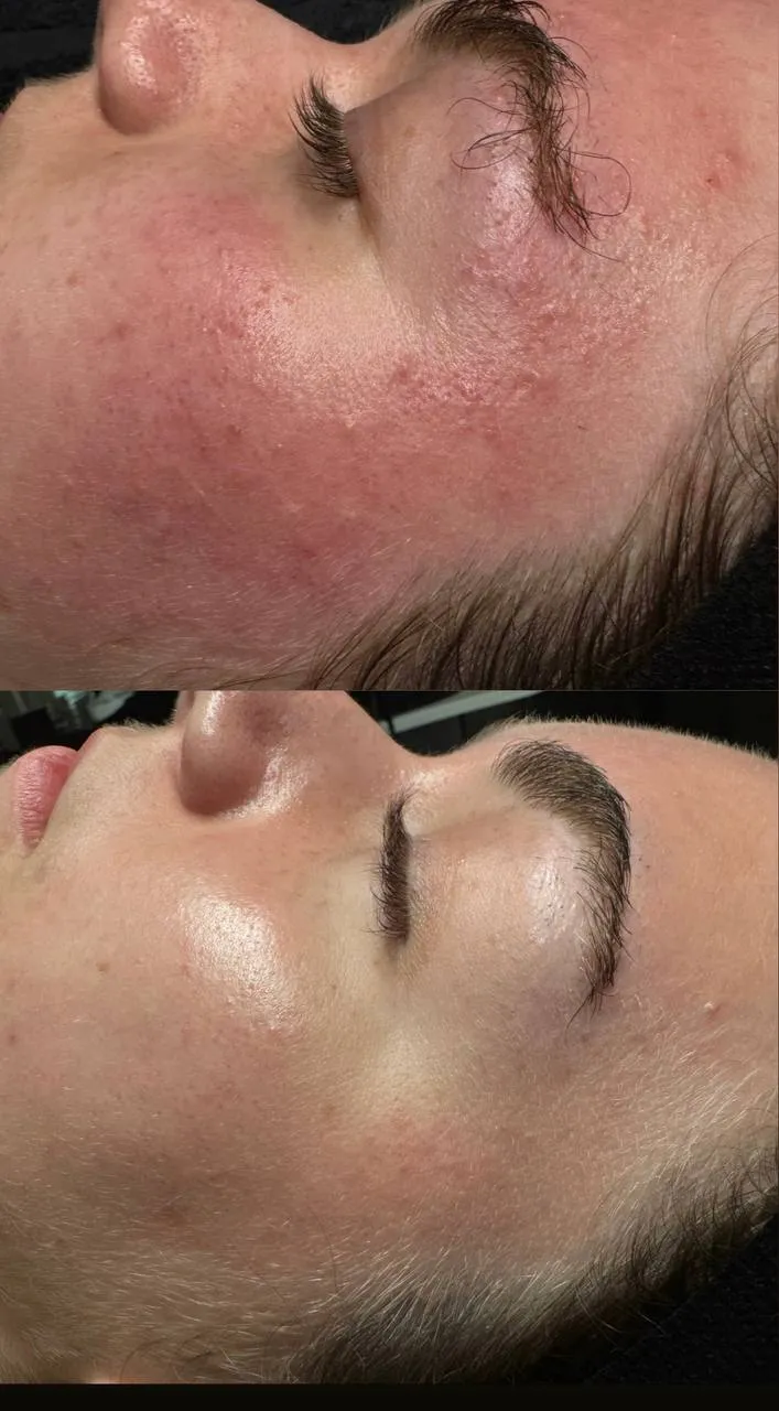 Before and after Glacial Rx CryoFacial at Revive Point: cheek with visible redness before, calmer and more even skin tone after