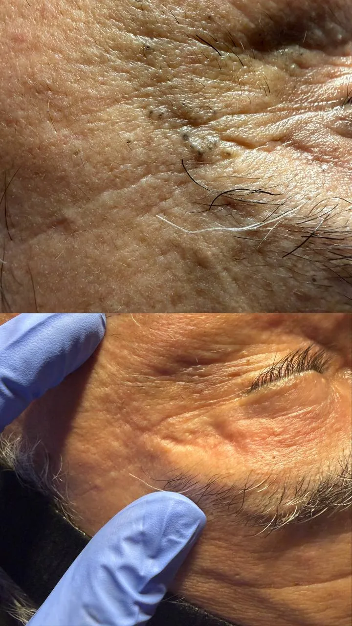 Before and after SkinPen microchanneling at Revive Point: close-up of the eye area showing smoother texture and softer fine lines